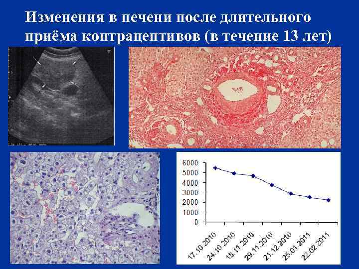 Изменения в печени после длительного приёма контрацептивов (в течение 13 лет) 