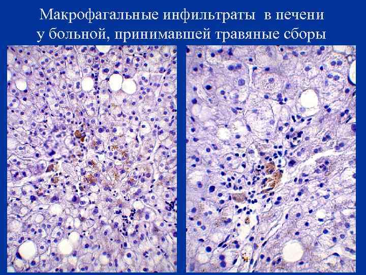 Макрофагальные инфильтраты в печени у больной, принимавшей травяные сборы 