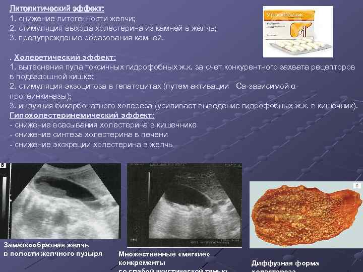 Литолитический эффект: 1. снижение литогенности желчи; 2. стимуляция выхода холестерина из камней в желчь;