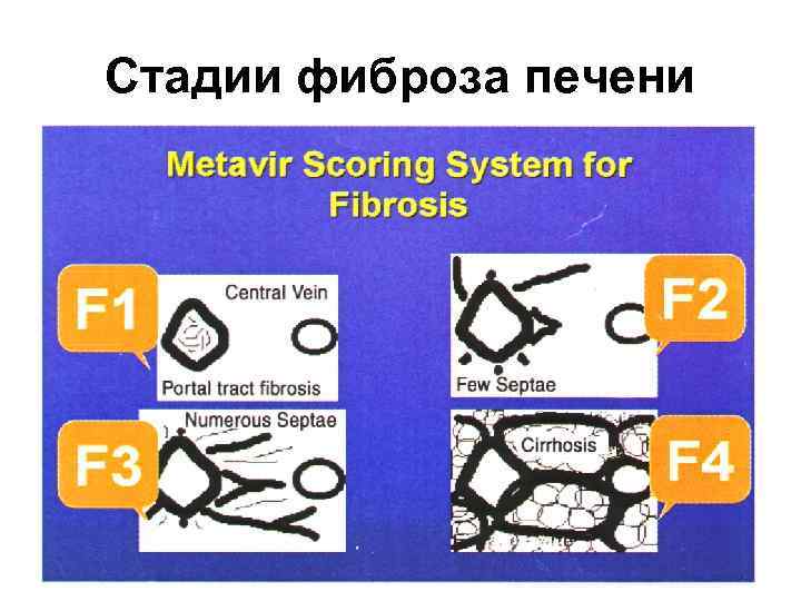 Стадии фиброза печени 