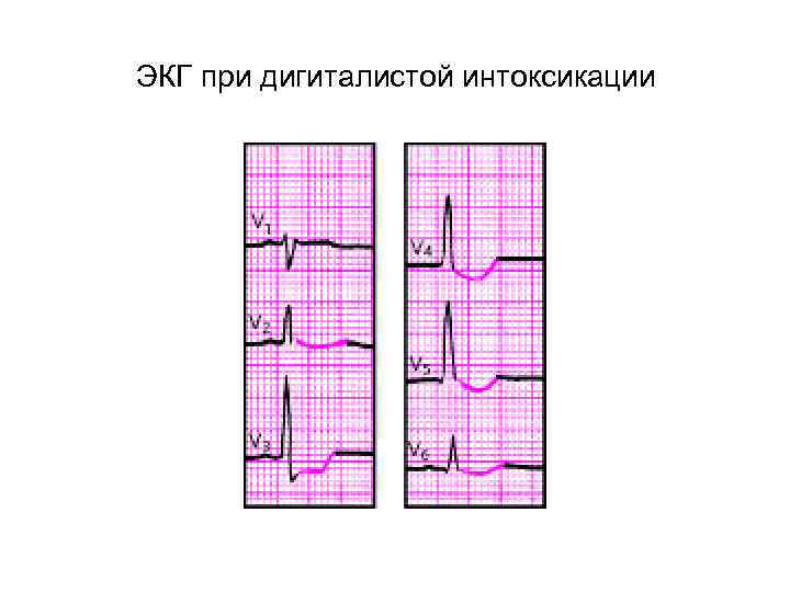 ЭКГ при дигиталистой интоксикации 