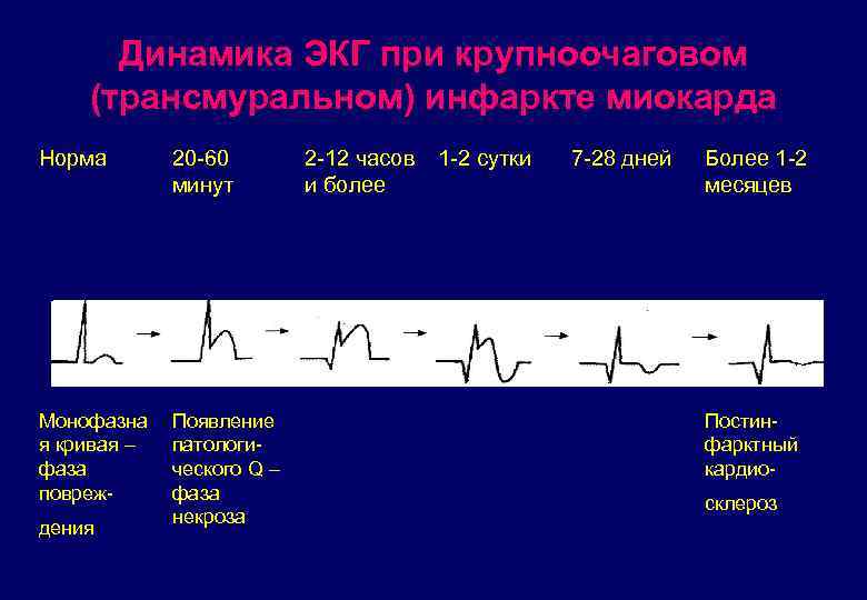 Динамика ЭКГ при крупноочаговом (трансмуральном) инфаркте миокарда Норма 20 -60 минут Монофазна я кривая