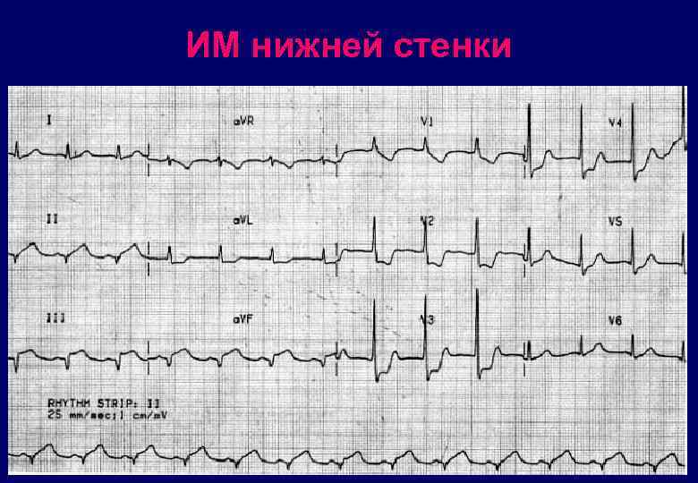 ИМ нижней стенки 