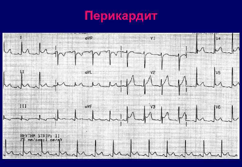 Перикардит 