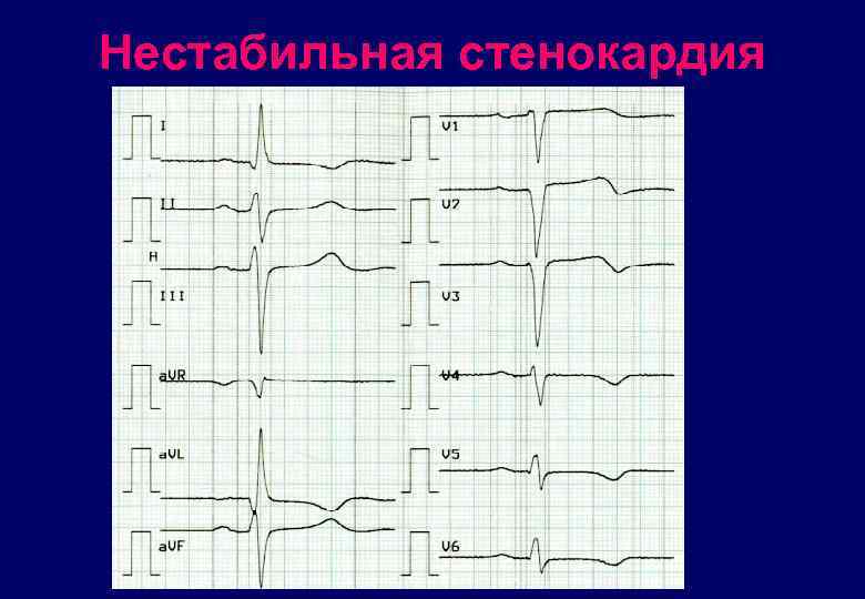 Нестабильная стенокардия карта смп