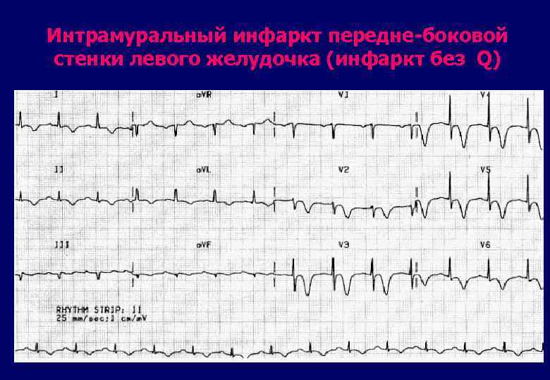 Интрамуральный инфаркт передне-боковой стенки левого желудочка (инфаркт без Q) 