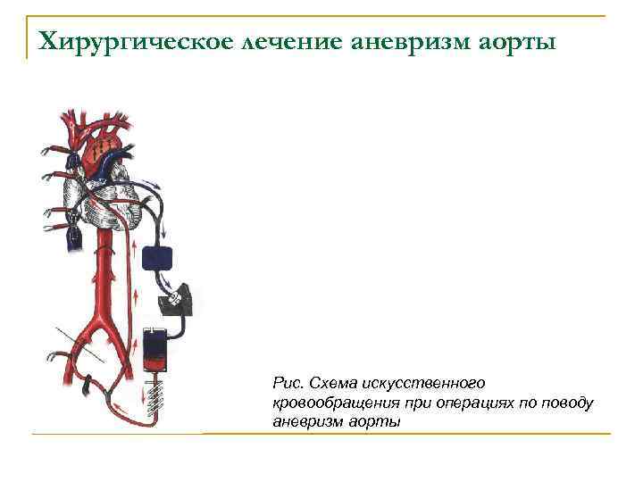 Хирургическое лечение аневризм аорты Рис. Схема искусственного кровообращения при операциях по поводу аневризм аорты