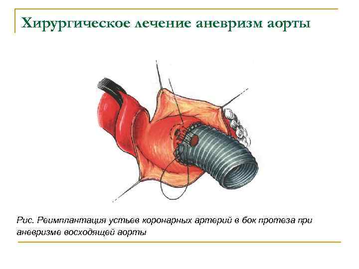 Операция бенталла де боно схема