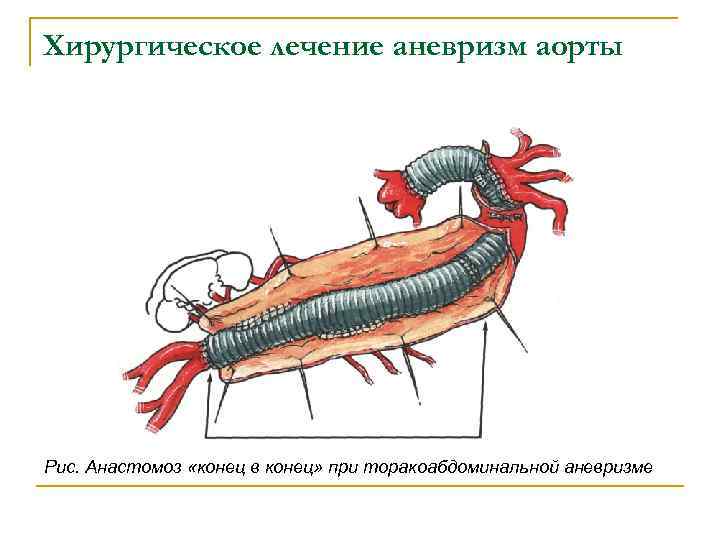 Хирургическое лечение аневризм аорты Рис. Анастомоз «конец в конец» при торакоабдоминальной аневризме 