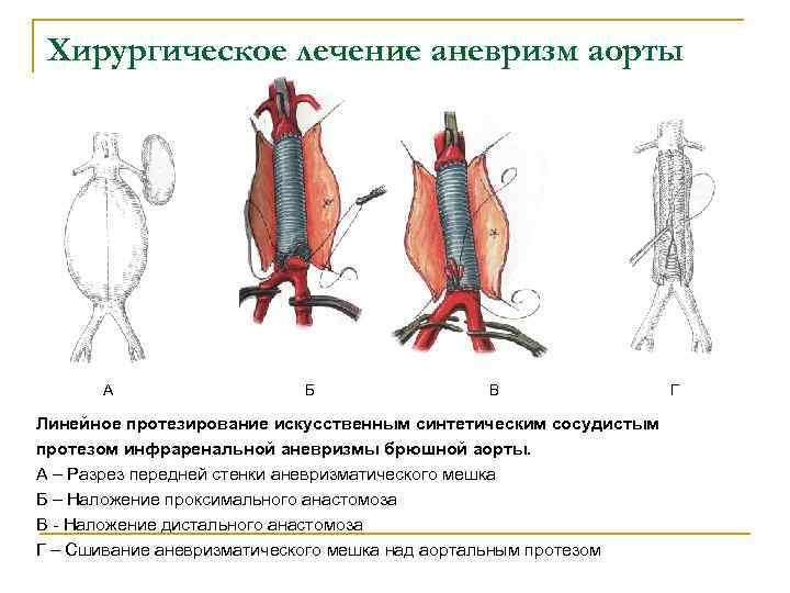 Виды аневризм по строению стенки