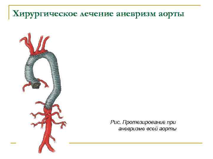 Язва аорты. Хирургическое лечение аневризмы аорты. Классификация аневризм аорты. Виды аневризм аорты по форме.