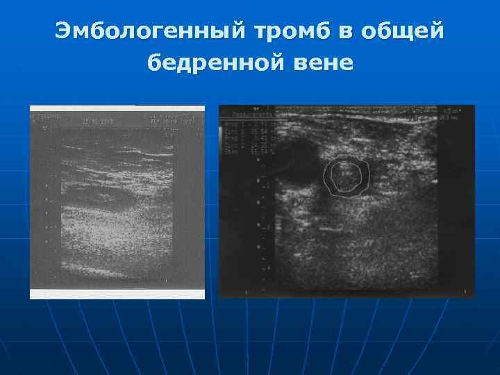 Эмбологенный тромб в общей бедренной вене 