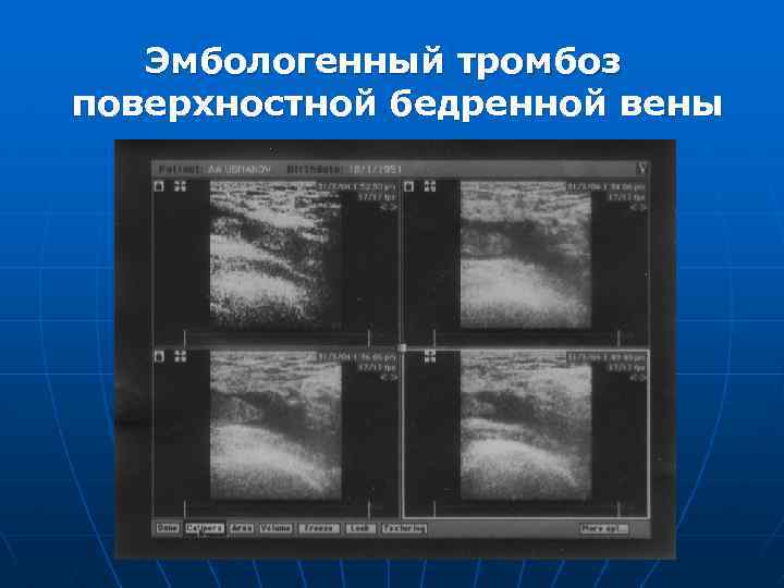 Эмбологенный тромбоз поверхностной бедренной вены 