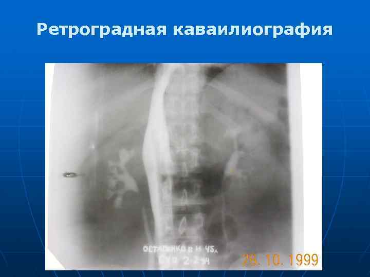 Ретроградная каваилиография 