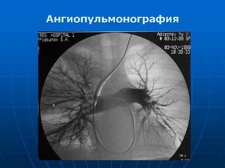 Ангиопульмонография 