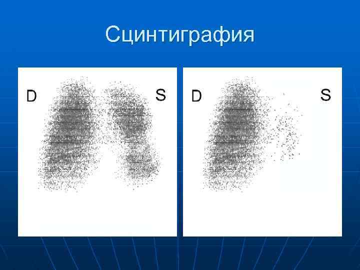 Сцинтиграфия 