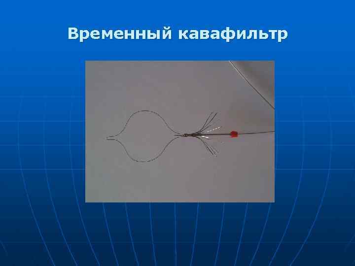 Временный кавафильтр 