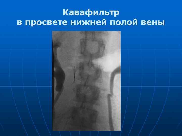 Кавафильтр в просвете нижней полой вены 