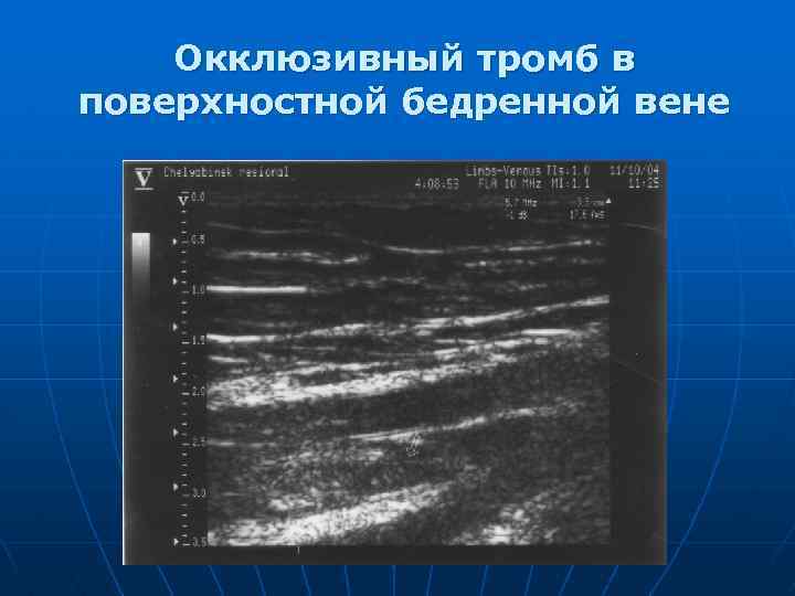 Окклюзивный тромб в поверхностной бедренной вене 