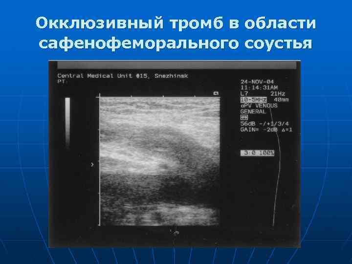 Окклюзивный тромб в области сафенофеморального соустья 