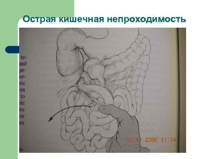 Помощь при кишечной непроходимости