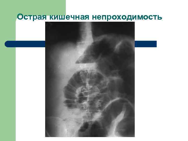 Острая кишечная непроходимость этиология