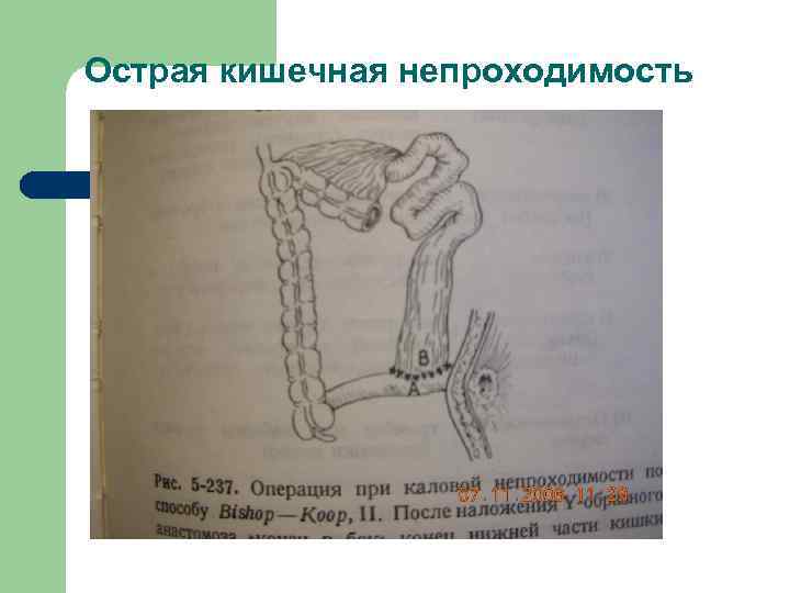 Острая кишечная непроходимость карта