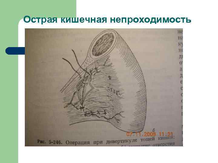 Острая кишечная непроходимость карта