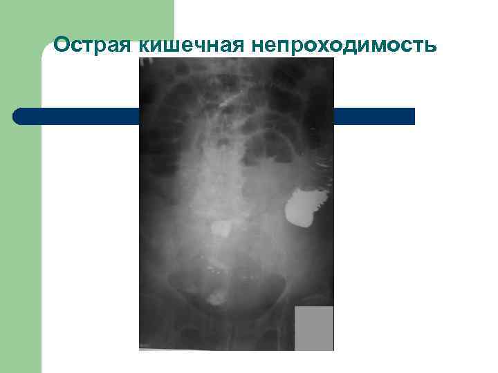 Острая кишечная непроходимость