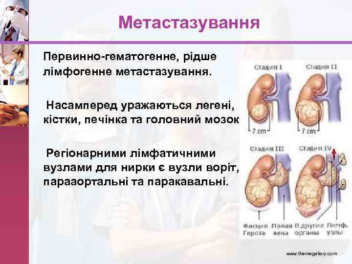 Метастазування Первинно-гематогенне, рідше лімфогенне метастазування. Насамперед уражаються легені, кістки, печінка та головний мозок. Регіонарними