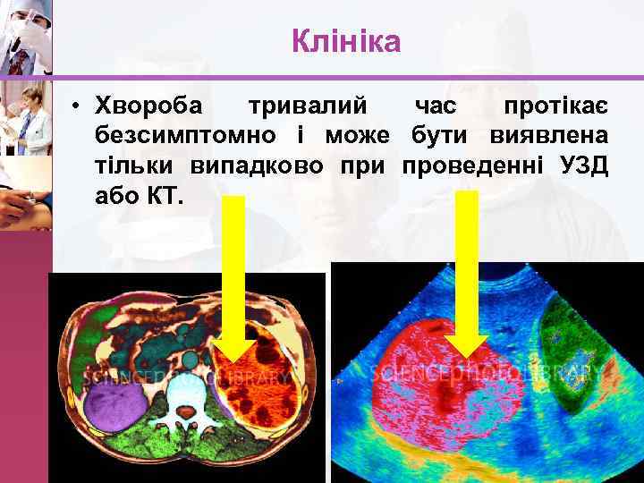 Клініка • Хвороба тривалий час протікає безсимптомно і може бути виявлена тільки випадково при