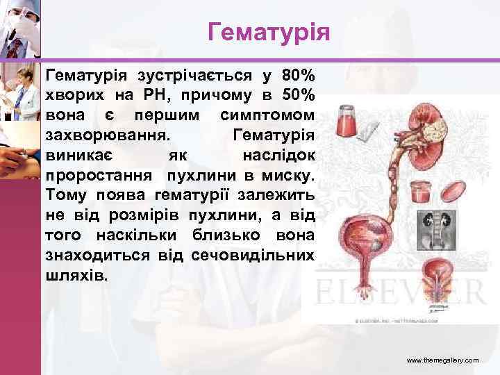 Гематурія • Гематурія зустрічається у 80% хворих на РН, причому в 50% вона є