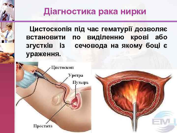 Діагностика рака нирки Цистоскопія під час гематурії дозволяє встановити по виділенню крові або згустків