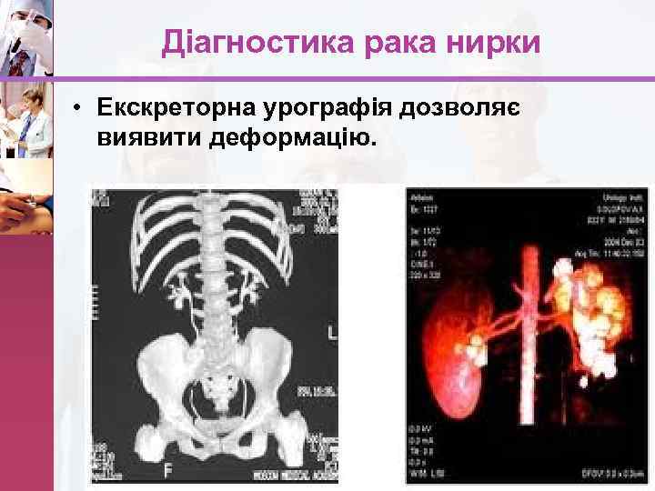 Діагностика рака нирки • Екскреторна урографія дозволяє виявити деформацію. www. themegallery. com 