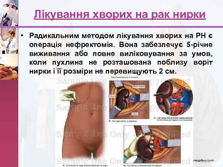 Лікування хворих на рак нирки • Радикальним методом лікування хворих на РН є операція