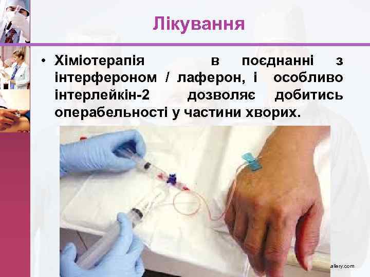 Лікування • Хіміотерапія в поєднанні з інтерфероном / лаферон, і особливо інтерлейкін-2 дозволяє добитись