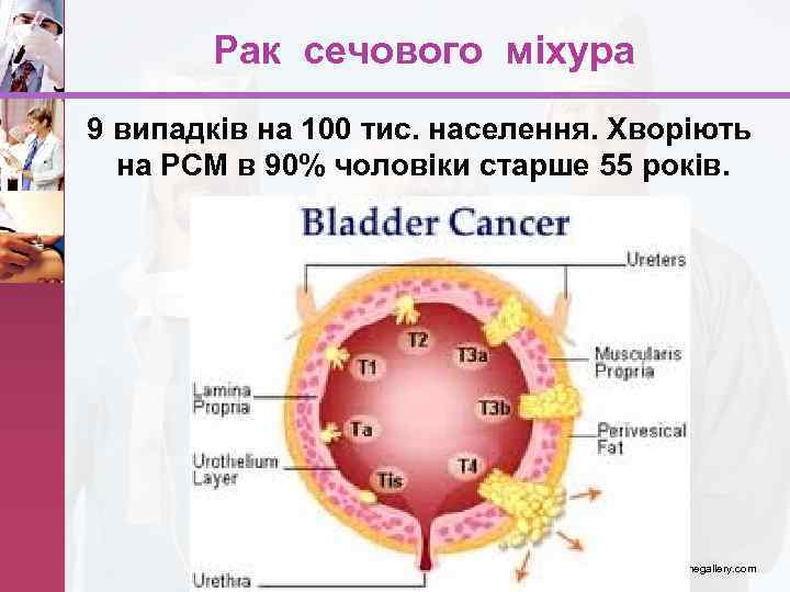 Рак сечового міхура 9 випадків на 100 тис. населення. Хворіють на РСМ в 90%