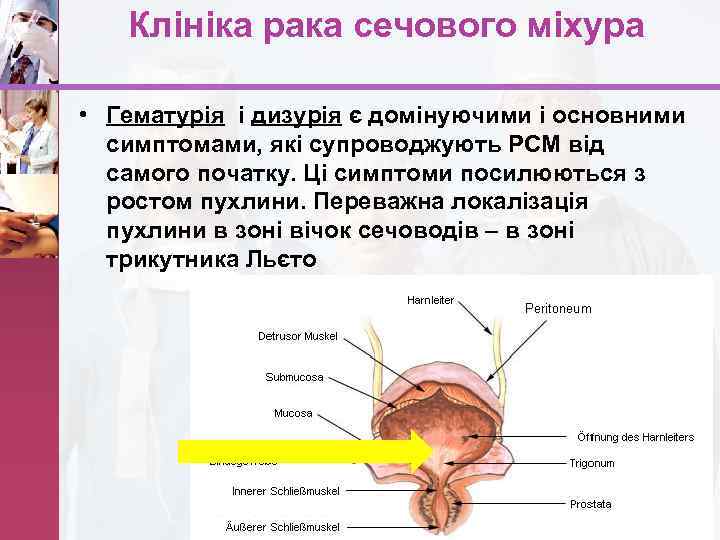 Клініка рака сечового міхура • Гематурія і дизурія є домінуючими і основними симптомами, які
