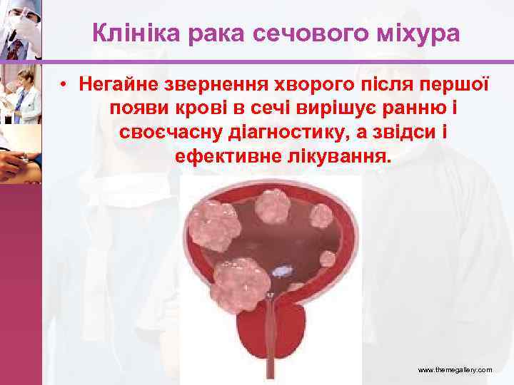 Клініка рака сечового міхура • Негайне звернення хворого після першої появи крові в сечі