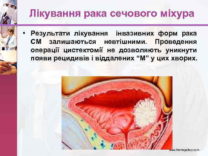 Лікування рака сечового міхура • Результати лікування інвазивних форм рака СМ залишаються невтішними. Проведення