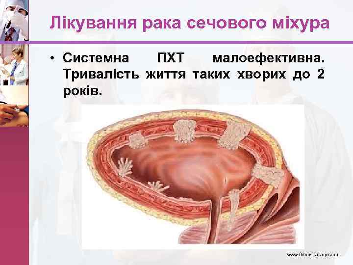 Лікування рака сечового міхура • Системна ПХТ малоефективна. Тривалість життя таких хворих до 2