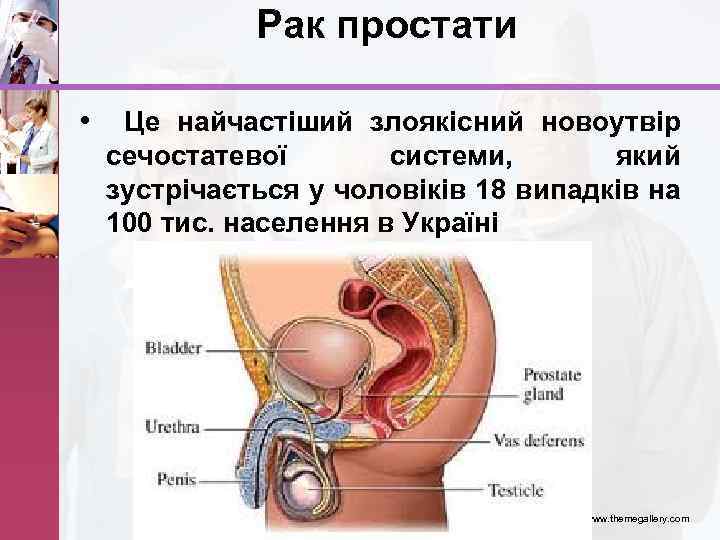 Рак простати • Це найчастіший злоякісний новоутвір сечостатевої системи, який зустрічається у чоловіків 18