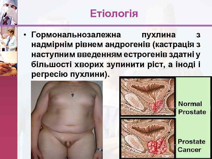 Етіологія • Гормональнозалежна пухлина з надмірнім рівнем андрогенів (кастрація з наступним введенням естрогенів здатні