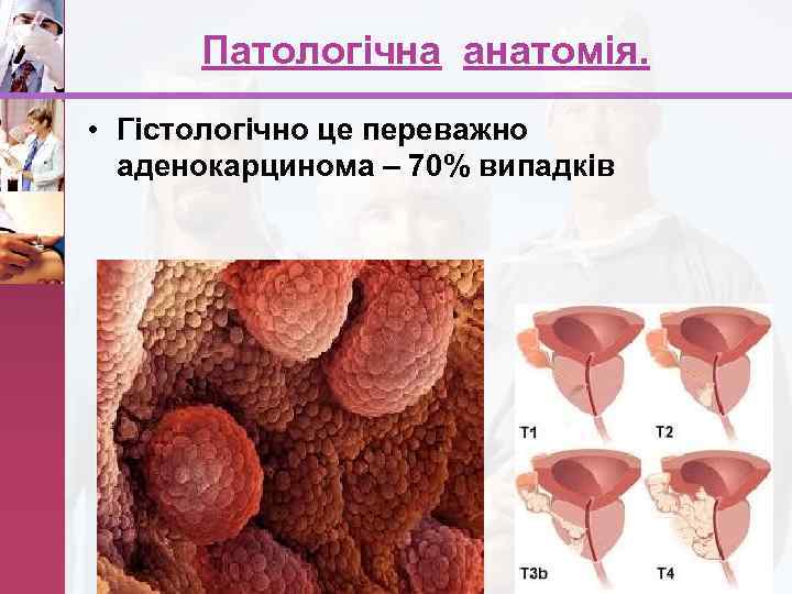 Патологічна анатомія. • Гістологічно це переважно аденокарцинома – 70% випадків www. themegallery. com 