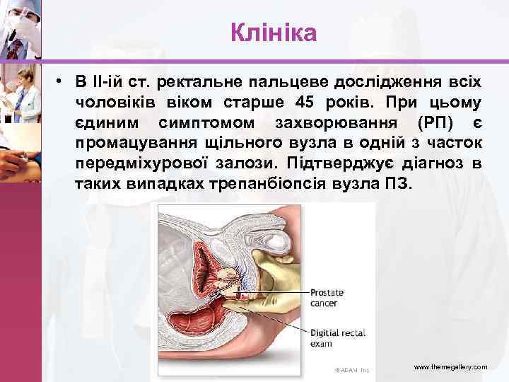 Клініка • В ІІ-ій ст. ректальне пальцеве дослідження всіх чоловіків віком старше 45 років.