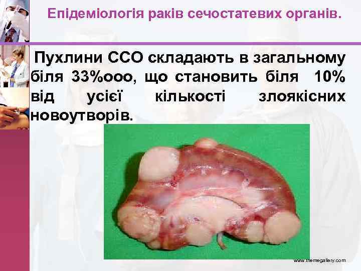 Епідеміологія раків сечостатевих органів. Пухлини ССО складають в загальному біля 33%ооо, що становить біля