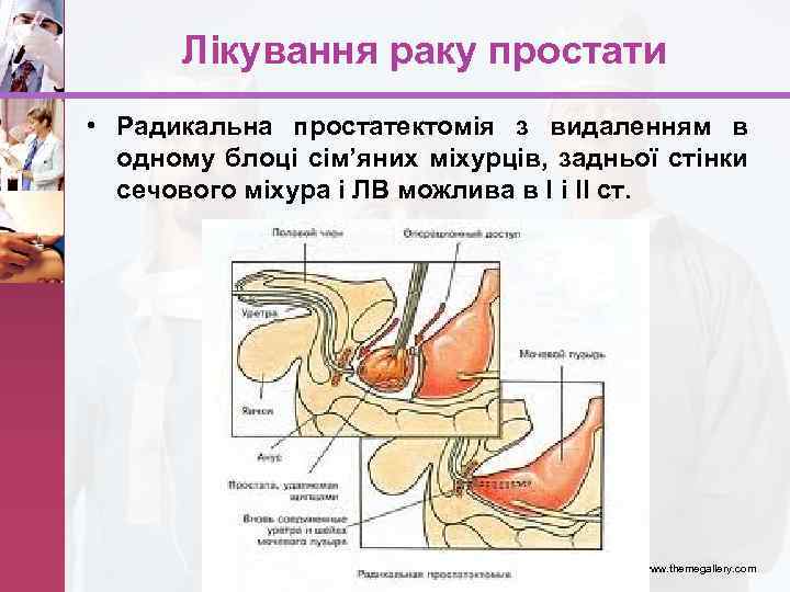 Лікування раку простати • Радикальна простатектомія з видаленням в одному блоці сім’яних міхурців, задньої