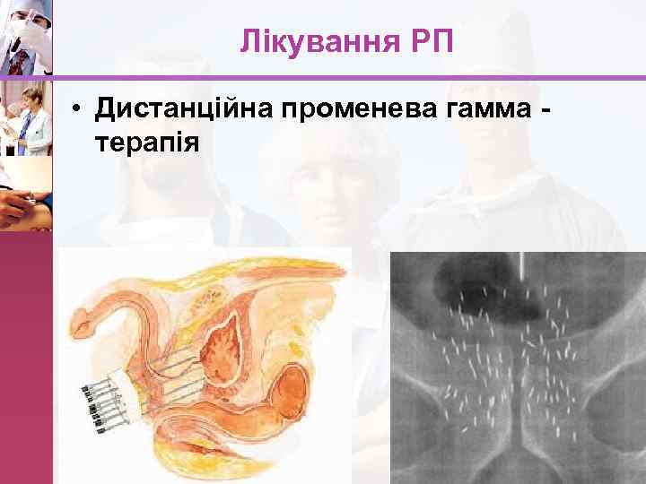 Лікування РП • Дистанційна променева гамма - терапія www. themegallery. com 