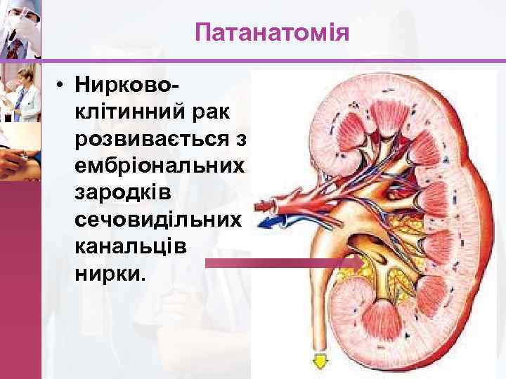 Патанатомія • Нирковоклітинний рак розвивається з ембріональних зародків сечовидільних канальців нирки. www. themegallery. com