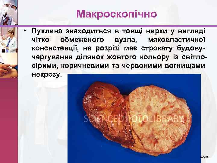 Макроскопічно • Пухлина знаходиться в товщі нирки у вигляді чітко обмеженого вузла, мякоеластичної консистенції,